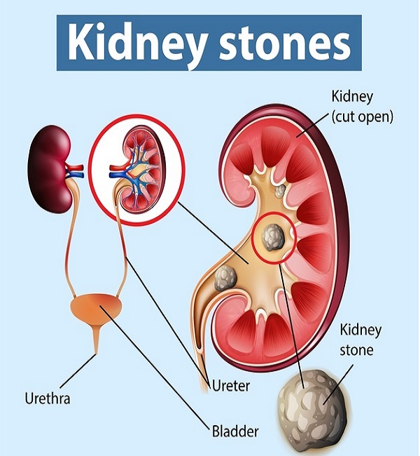 kidney-pain-location